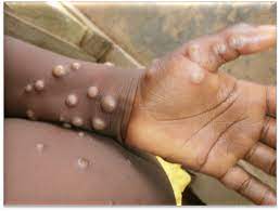 Spread of monkeypox virus outbreak slows