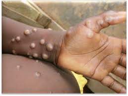 Monkeypox on dark skin.